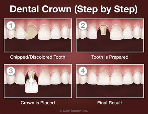 crown metal fabrications|procedure for a dental crown.